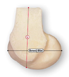 Còndil femoral osteoarticular