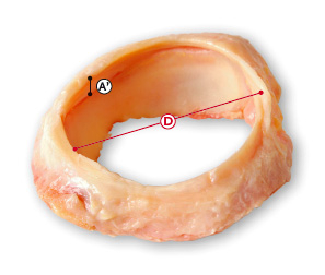 Labrum acetabuli (rodet acetabular)